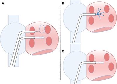 A simplified single transseptal puncture approach using high-density 3D voltage mapping for atrial fibrillation ablation: acute complications and long-term results